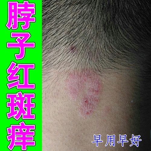 脖子红斑痒掉屑神经性过敏粗糙鳞屑痒长红疙瘩痘感染刺挠抓红痒膏
