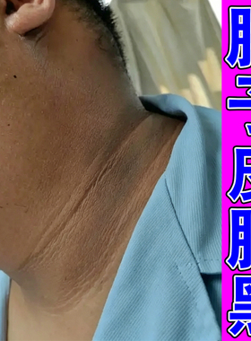 去颈部脖子黑洗不干净修复膏去脖子黑皮肤膏黑色素沉淀