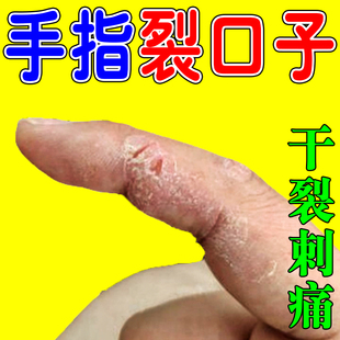 手指头裂口子干裂修复霜秋冬季手开裂手干燥粗糙
