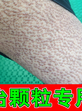 专用冶疗顽固后背小腿上黑色素沉淀粗糙小颗粒膏