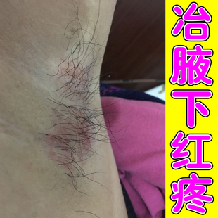 胳肢窝红疼难受大腿根摩擦红肿疼潮湿闷捂皮肤泛红发肿