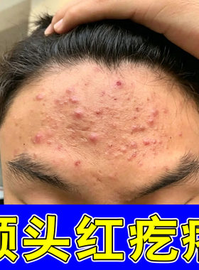额头上长疙瘩闭口粉刺的软膏儿童脸部长小疙瘩淡化修复