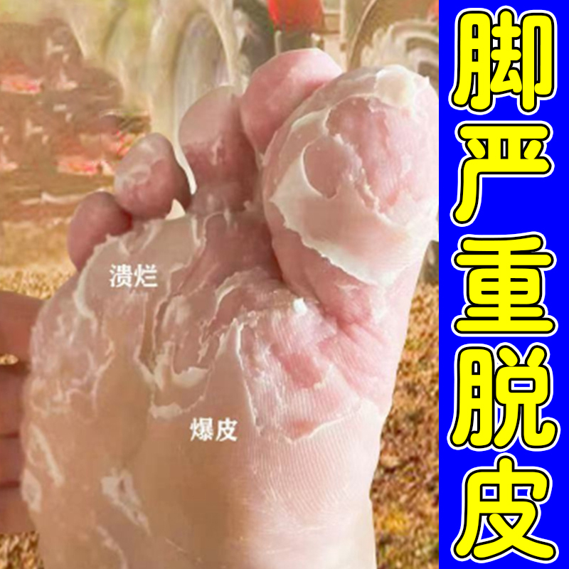 脚严重脱皮脚底脚心爆皮粗糙干裂脚趾头掉皮起皮脚丫脱皮脚痒软膏