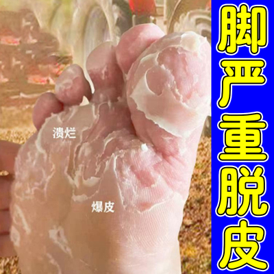 脚严重脱皮脚底脚心爆皮粗糙干裂脚趾头掉皮起皮脚丫脱皮脚痒软膏
