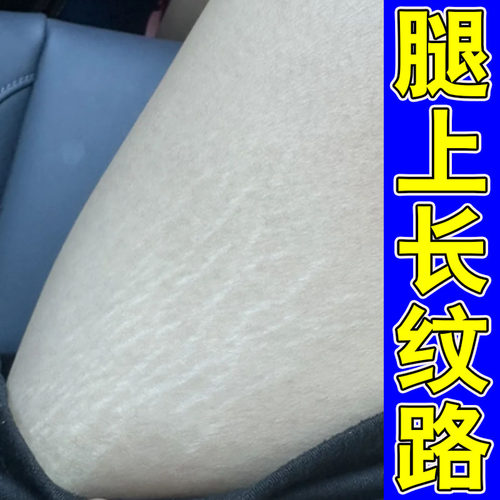 青少年肥胖纹霜淡化生长纹膏专用大腿学生专用修复膏