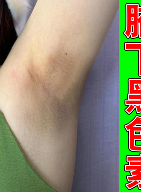 肢窝黑外用修复腋窝腋下皮肤发黑夏天胳脖子黑色素沉淀专用