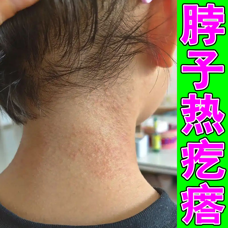 热痱水成人痒去痱子喷雾液天热大皮肤消毒护理（消）