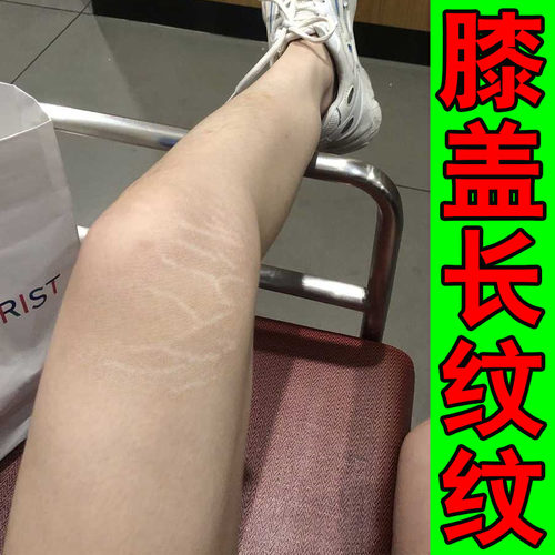 去肥胖纹修复霜生长纹生长期腿上身上长纹淡纹专用