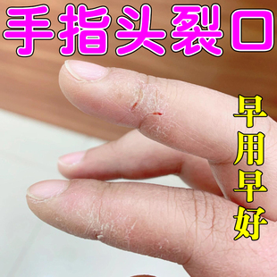 手指头裂口干裂修复霜秋冬手干燥粗糙起硬皮掉皮膏