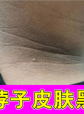 去脖子黑色素沉淀黑黑洗不干净粗糙专用膏