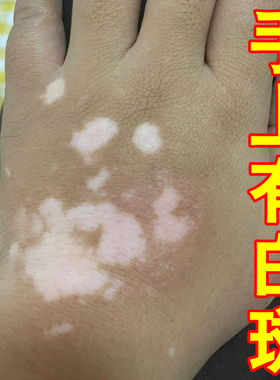 手背长白色斑黑色素淡化手上白斑专用乳膏