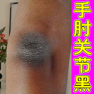 手肘关节黑手臂胳膊肘发黑黑棘皮脖子腋下黑色素沉淀变白神器