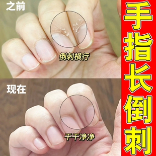 手指起倒刺修复手干裂起皮手指防倒刺儿童去指甲边缘肉刺死皮神器