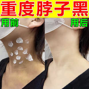 脖子黑色素沉淀黑棘皮洗不干净黑脖子变白神器