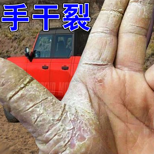手干裂修复膏手指裂口干裂粗糙手指头开裂口