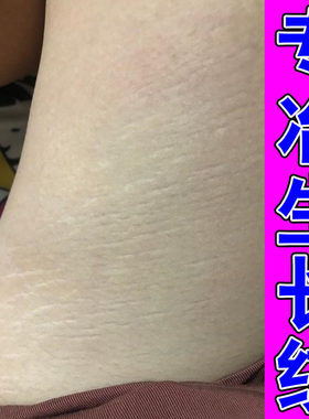 去肥胖纹生长纹修复霜大腿学生腰腹上肥胖纹去除男女通用膏