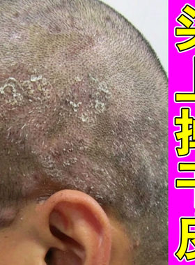 头皮屑脂溢性头皮痒头上长疙瘩起干皮专用