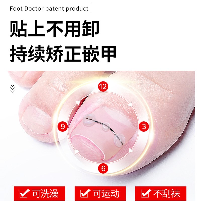 脚医生甲沟嵌甲炎矫正器指甲往肉里长正甲贴片卷甲脚趾甲矫正神器