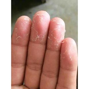 手脱皮手指头掉皮起皮死皮手掌手心蜕皮起硬皮手指尖脱皮外用乳膏
