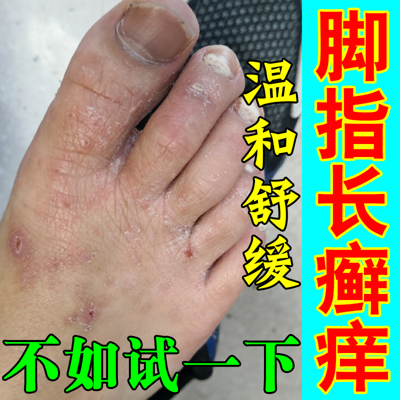 脚趾关节癣痒脚面长红斑