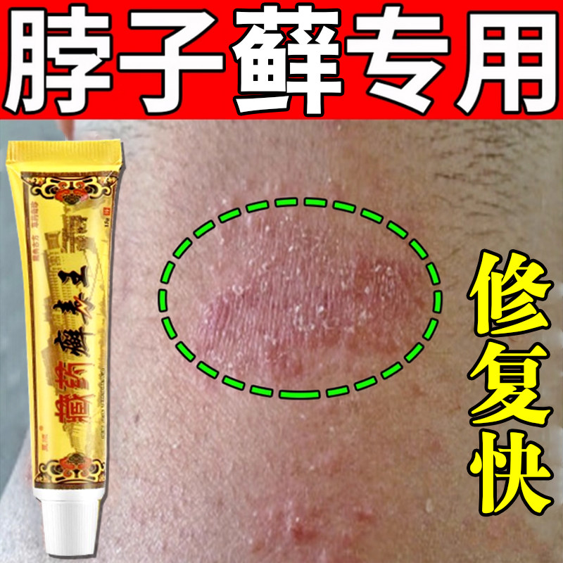 脖子上长癣藓痒颈部后面