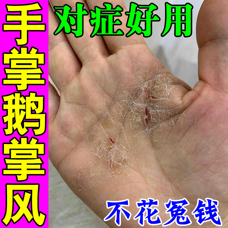 鹅掌风专用药治疗手掌干裂脱皮真菌感染手气手痒手上起水泡痒膏药