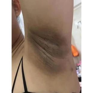 腋下变白去黑黑色素沉淀去除淡化大腿内侧黑脖子黑棘皮腋窝黑专用