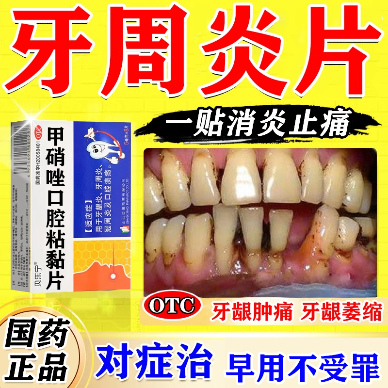 人工牛黄甲硝唑牙周炎片治牙痛牙龈肿痛专用药口腔溃疡贴特快效药