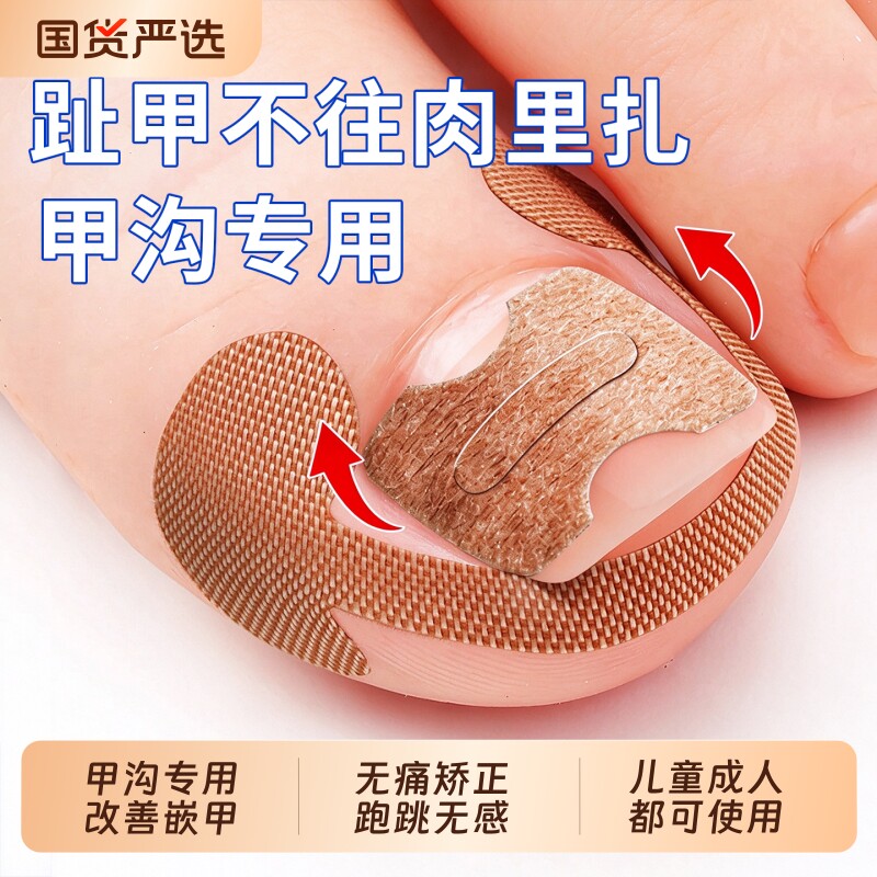 甲沟矫正器炎正甲贴指甲贴片嵌甲脚趾甲往肉里长专用垫片神器修脚