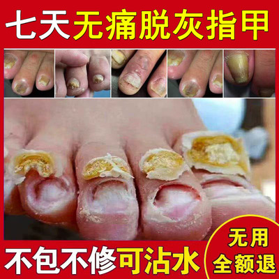 灰指甲脱甲膏专用抑菌液甲沟炎灰趾指甲快速脱甲精油脚指甲软化剂