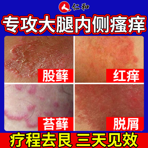 【仁和】盐酸特比萘芬乳膏1%*10g*1支/盒