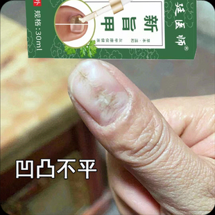 手指甲裂开甲板有裂缝指甲盖凹凸不平竖纹坏甲药修复护理