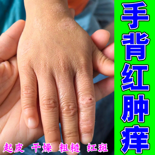 手背疙瘩痒沙土性过敏痒手背粗糙颗粒手指关节硬疙瘩痒专用草本