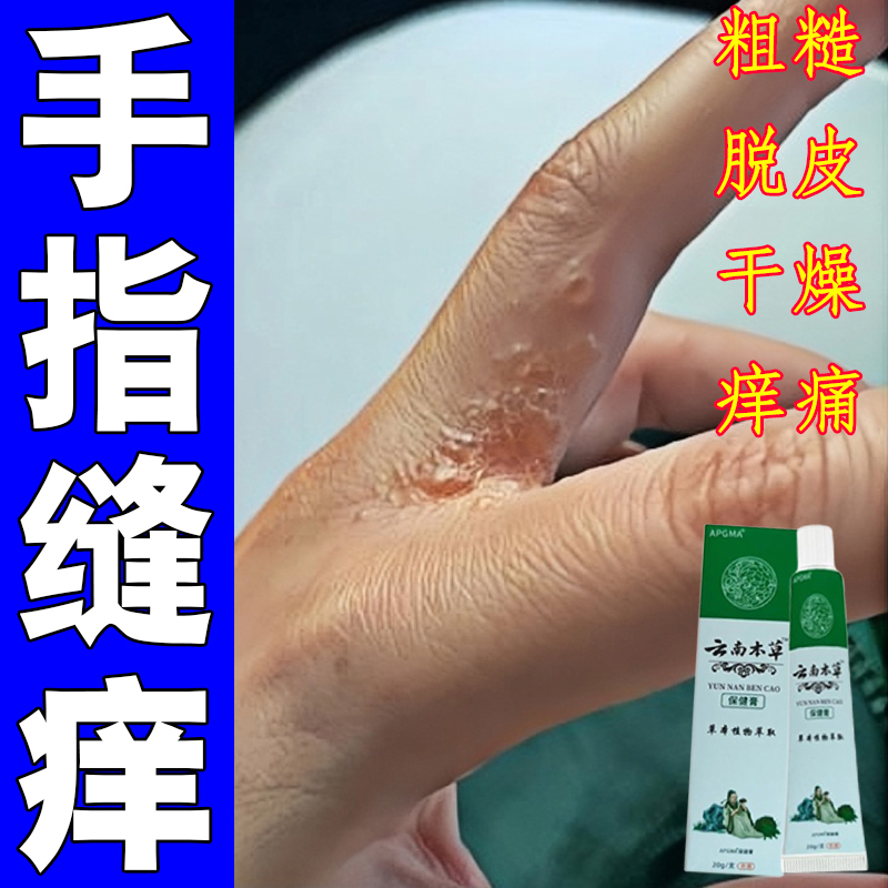 手指缝溃烂药膏经常碰水烂手丫洗洁精过敏指缝糜烂脱皮痒修复膏药