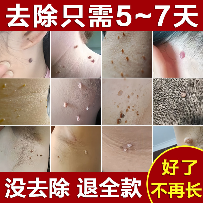 脖子上长小肉粒疙瘩去除神器丝状跖疣瘊立净膏官方旗舰店一抹无忧
