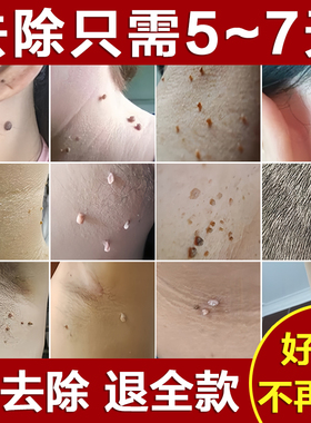 脖子上长小肉粒疙瘩去除神器祛猴血泡胞刺鱼鳞痣皮赘膏官方旗舰店