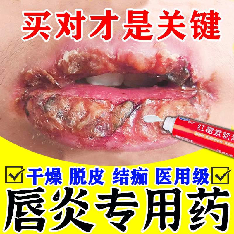 【福元】红霉素软膏1%*10g*1支/盒