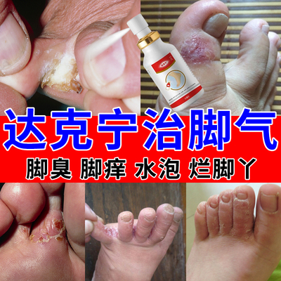 达克宁脚气止痒脱皮杀菌真菌感染烂脚丫脚趾缝脱皮脚痒糜烂专用药