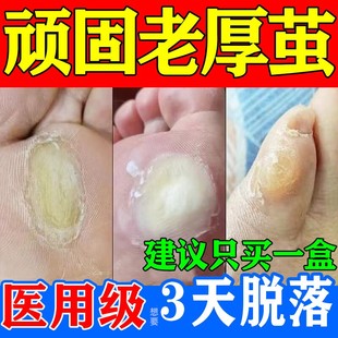 脚去死皮老茧鸡眼软化药脚钉祛除膏去脚底脚趾老茧水杨酸软膏正品