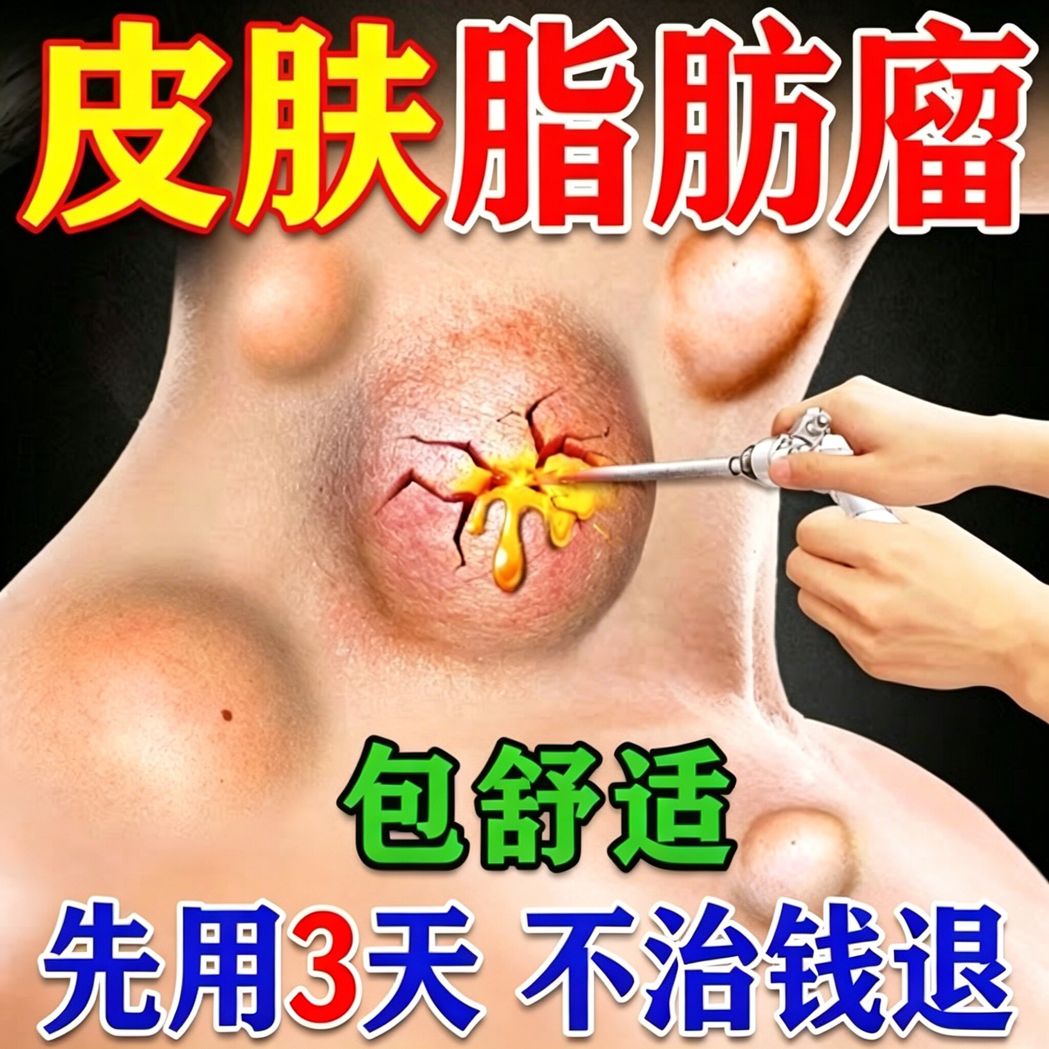治疗脂肪留消留膏药皮下脂肪留去除神器特专效用肿硬块鼓包脂肪康