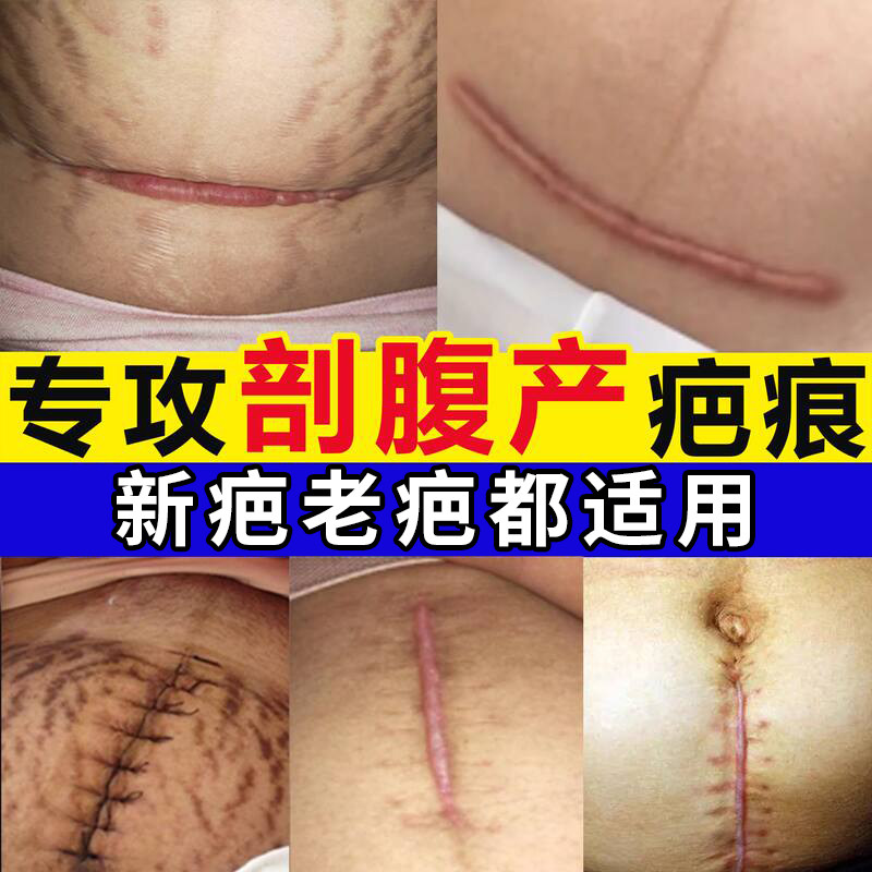 泰国花开半夏凝胶祛疤痕修复除疤膏医用去疤膏去疤痕修复无痕祛疤