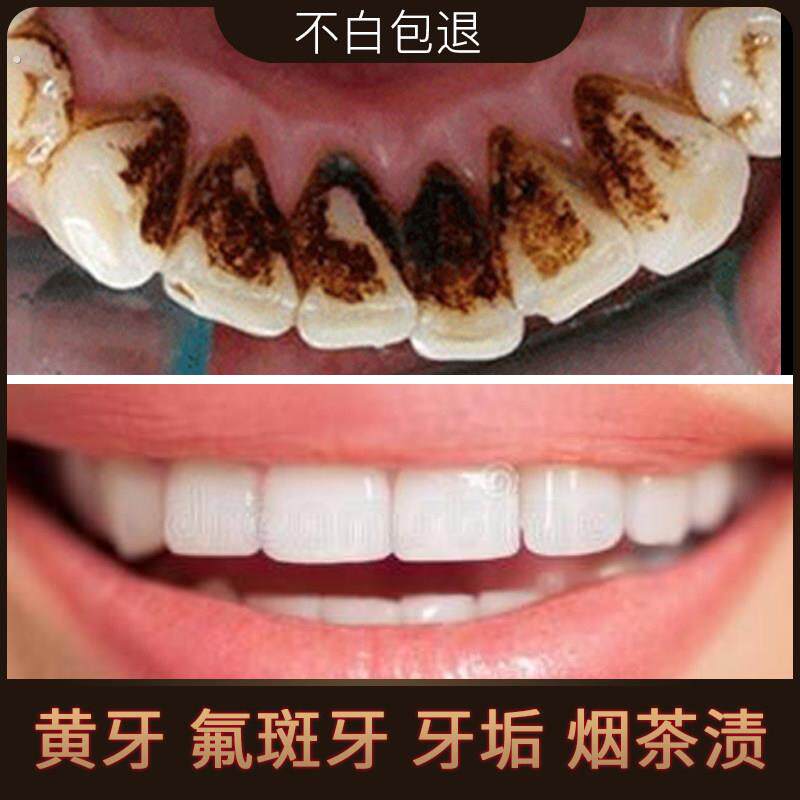 牙齿清洁神器工具结石去除溶解牙垢洗牙器家用清理清除牙石牙菌斑