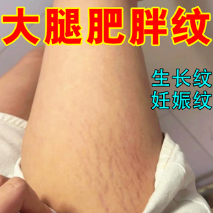 去肥胖纹修复霜生长纹消除学生大腿淡化妊娠纹精油祛紧致肚皮膏