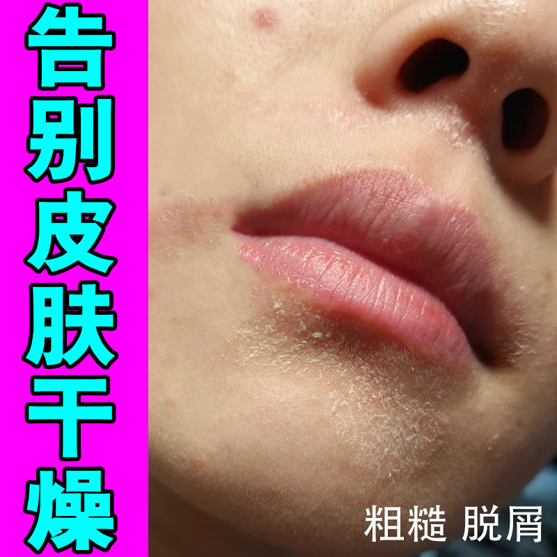 脸干皮嘴角下巴额头爆皮天气冷皮肤干燥粗糙皴泛红痒起小疙瘩痘痘