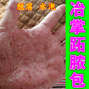 掌趾脓疱病症专用药治疗手脚脓包角化病手足疱干裂掌跖脓疱专用药