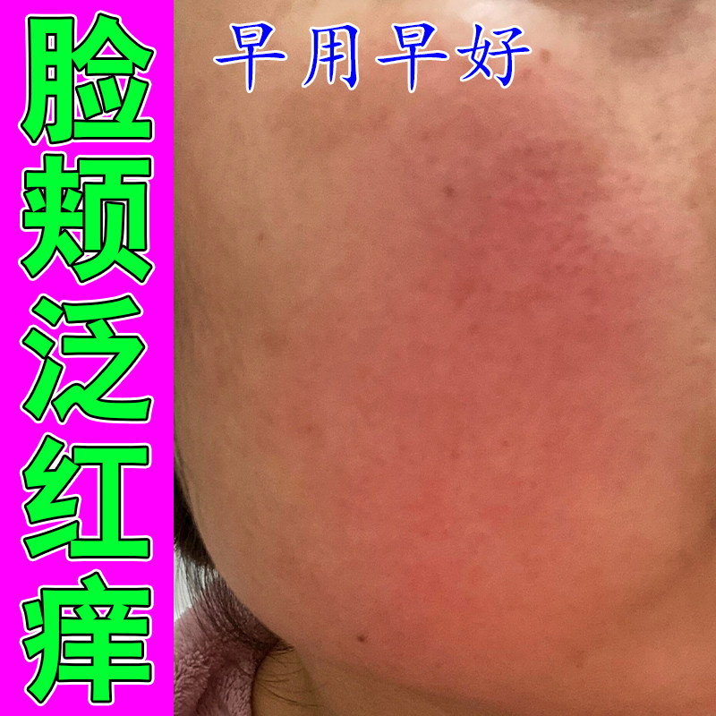 脸上长红血丝干燥起皮过敏皮肤红皮肤消毒护理（消）