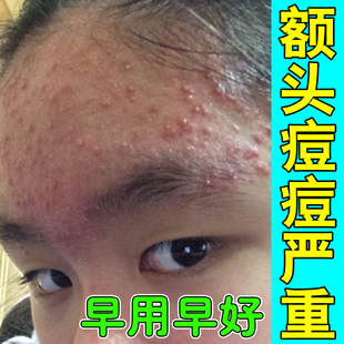 治额头痘痘闭口粉刺脸上起小疙瘩粉刺专用草本修护乳膏额头长痘痘