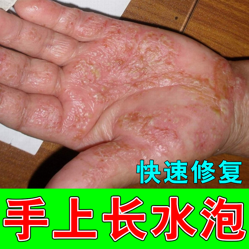 手上起小水泡痒疱汗疹感染汉状真菌专用小水泡湿痒修护膏