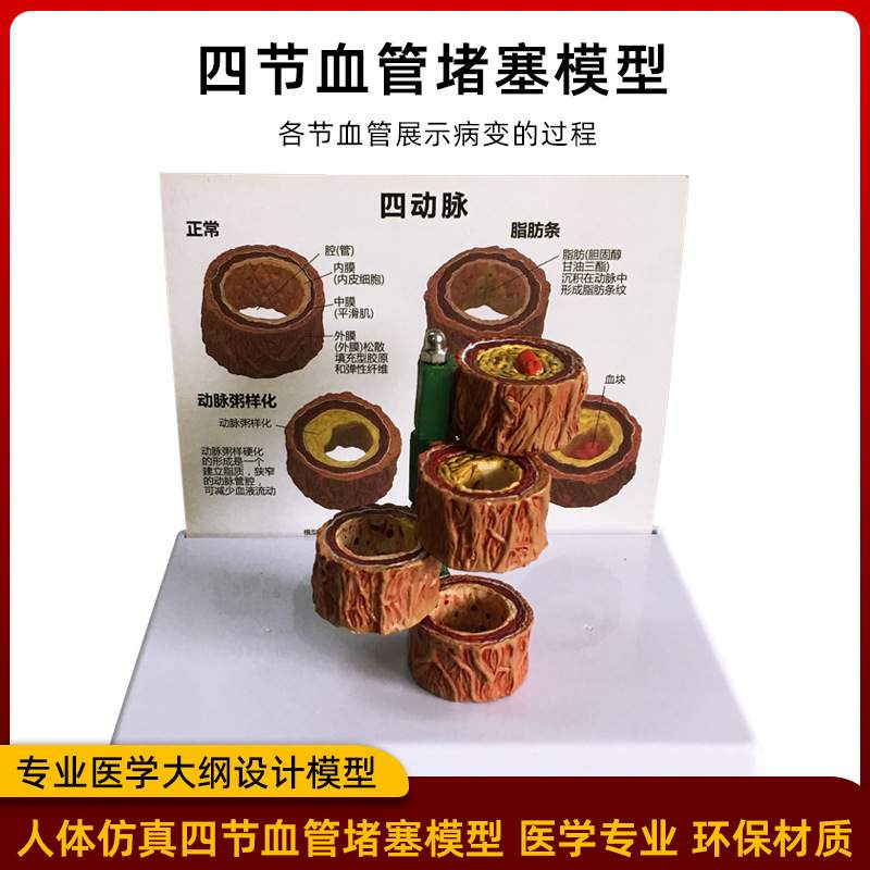 冠状动脉性心血管动脉模型硬化模型 人体病理模型血栓模型