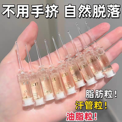 【涂抹自然落】脂肪粒去除神器眼部去油脂粒眼周颗粒汗管粒专用霜